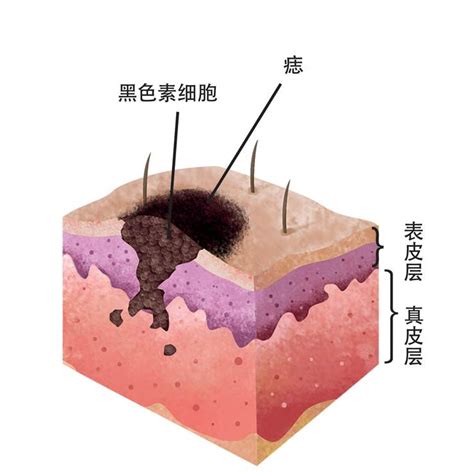 蒼蠅痣|痣形成的原因？痣長毛、痣變多變大是痣病變？5招判別